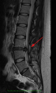 Disc prolapse